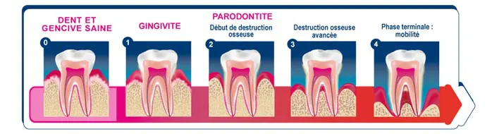 Parodontologie dentiste en Espagne